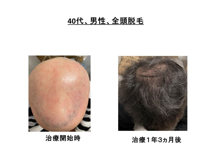 円形脱毛症　病院